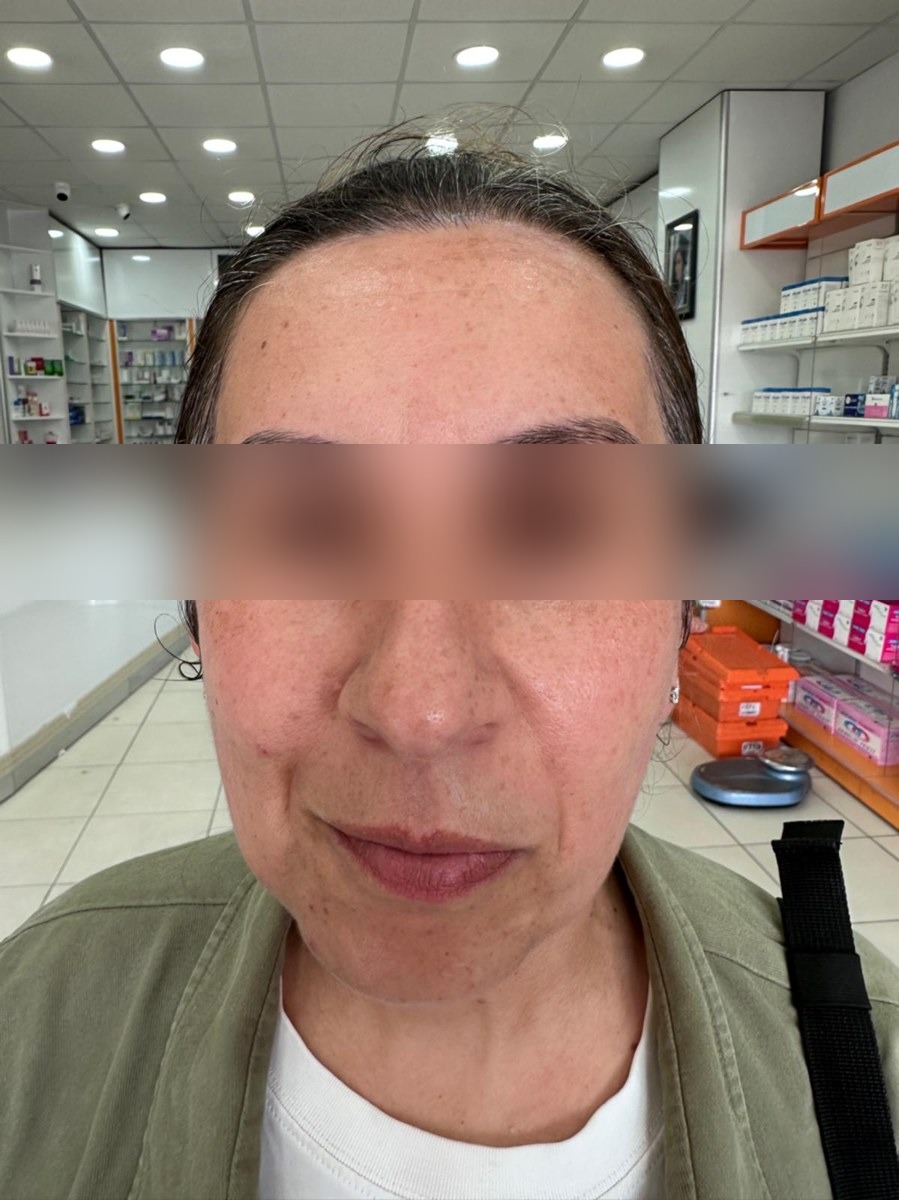 The same skin before and after a freshly formulated personaLab serum ritual